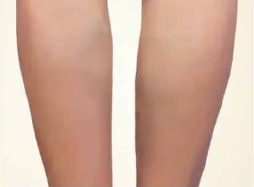 치료 후